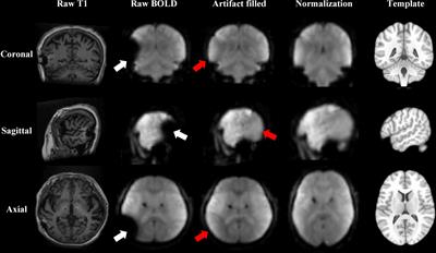 Deep Brain Stimulation Modulates Multiple Abnormal Resting-State Network Connectivity in Patients With Parkinson’s Disease